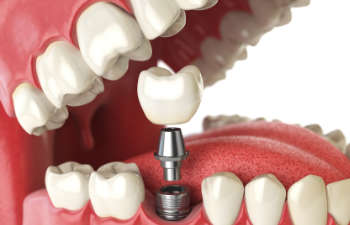 dental implant visualisation