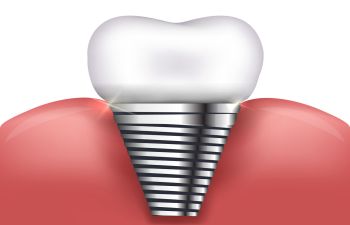 Dental Implants Marietta GA