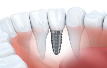 Dental Implant Model